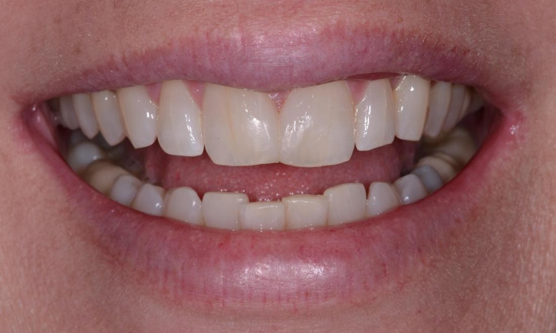 Bonding - Resin Veneers Before & After Photos