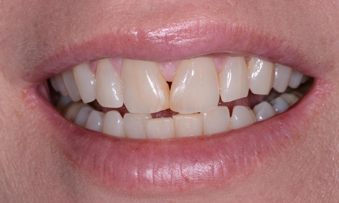 Bonding - Resin Veneers Before & After Photos