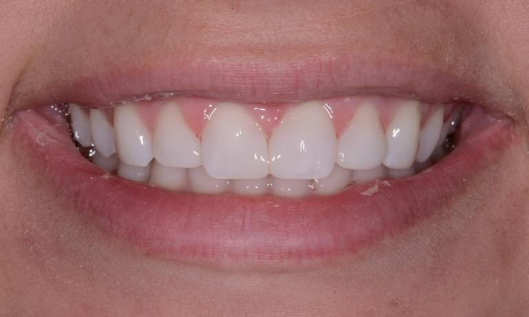Bonding-Resin-Veneers-After-Image
