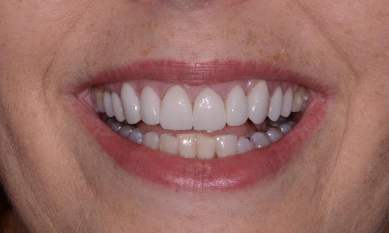 Porcelain-Veneers-After-Image