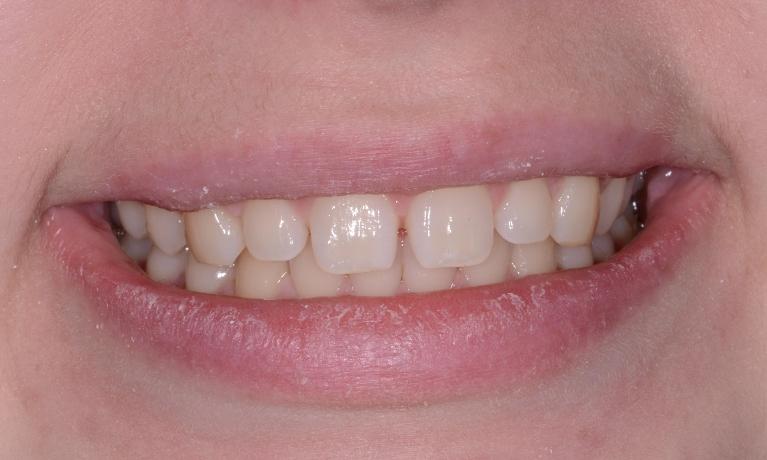 Bonding-Resin-Veneers-Before-Image