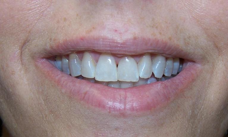 Porcelain-Veneers-Before-Image